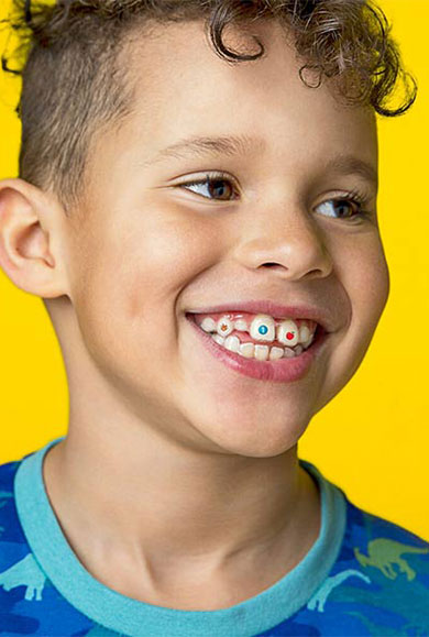 ınvisalign first Çocuklar İçin Şeffaf Plak Tedavisi